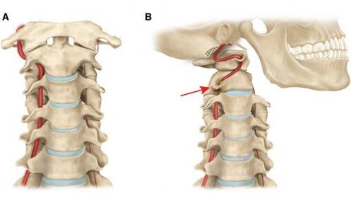 vertebral artery syndrome nga adunay cervix osteochondrosis