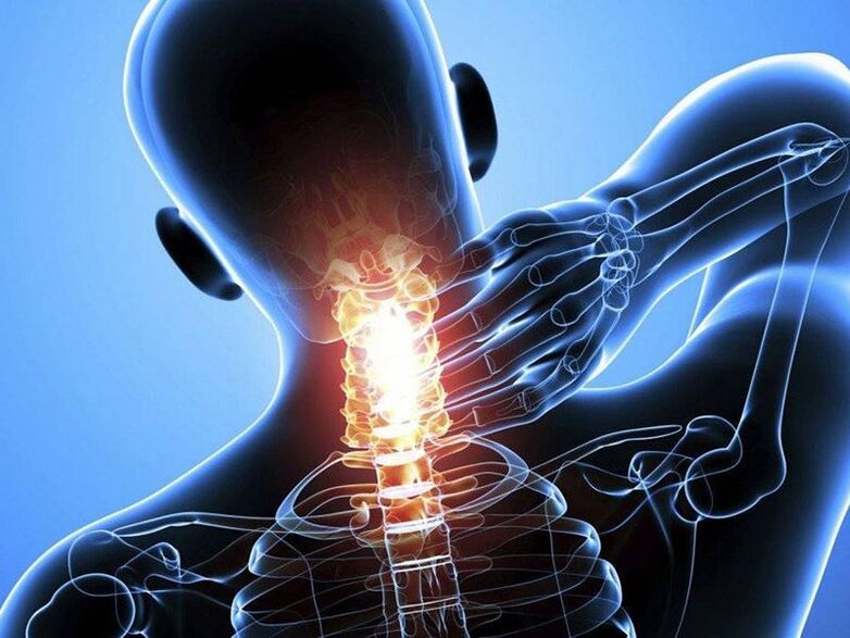 Ang Osteochondrosis sa cervical spine giubanan sa kasakit sa liog