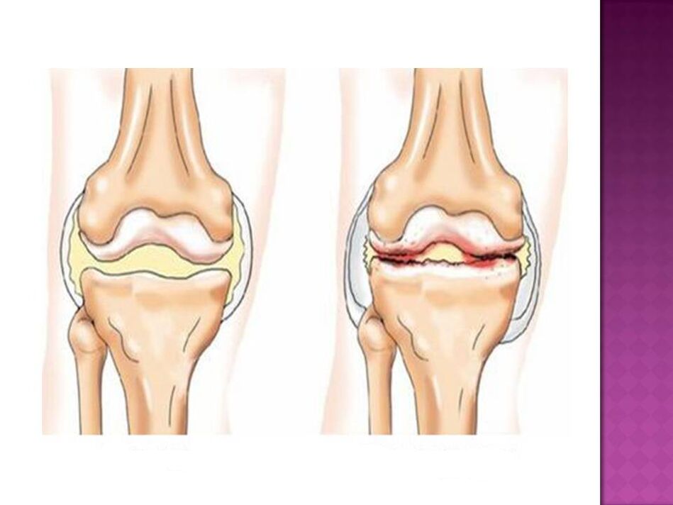 Ang lutahan normal (wala) ug apektado sa osteoarthritis (tuo)