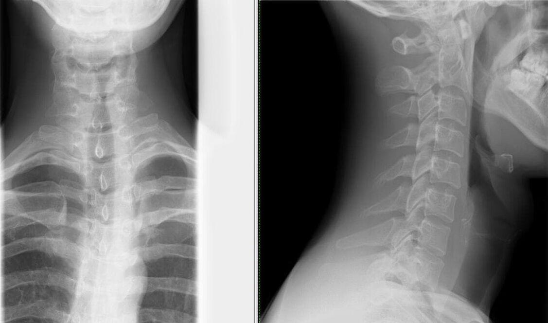 Ang X-ray sa dugokan usa ka yano ug epektibo nga pamaagi sa pagdayagnos sa osteochondrosis