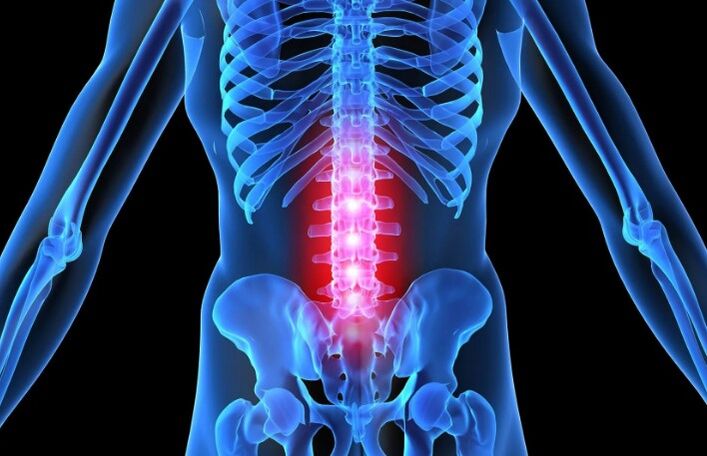 Osteochondrosis sa rehiyon sa lumbar