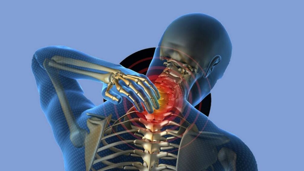 Osteochondrosis sa rehiyon sa cervical