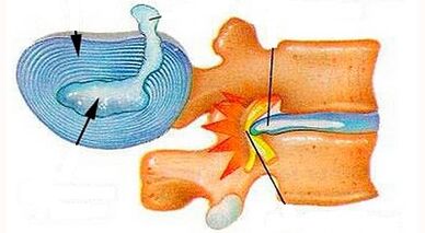 Mga Tampok sa Pag-uswag sa Cervical Osteochondrosis