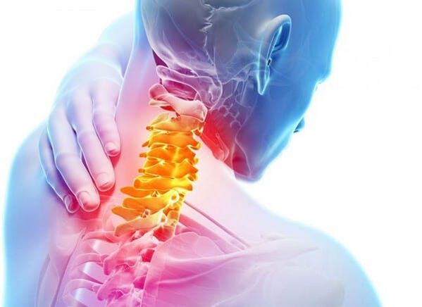 Osteochondrosis sa cervical spine