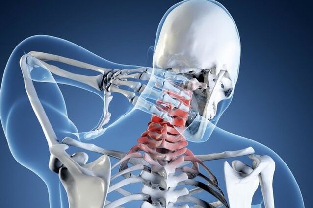 osteochondrosis sa cervical spine